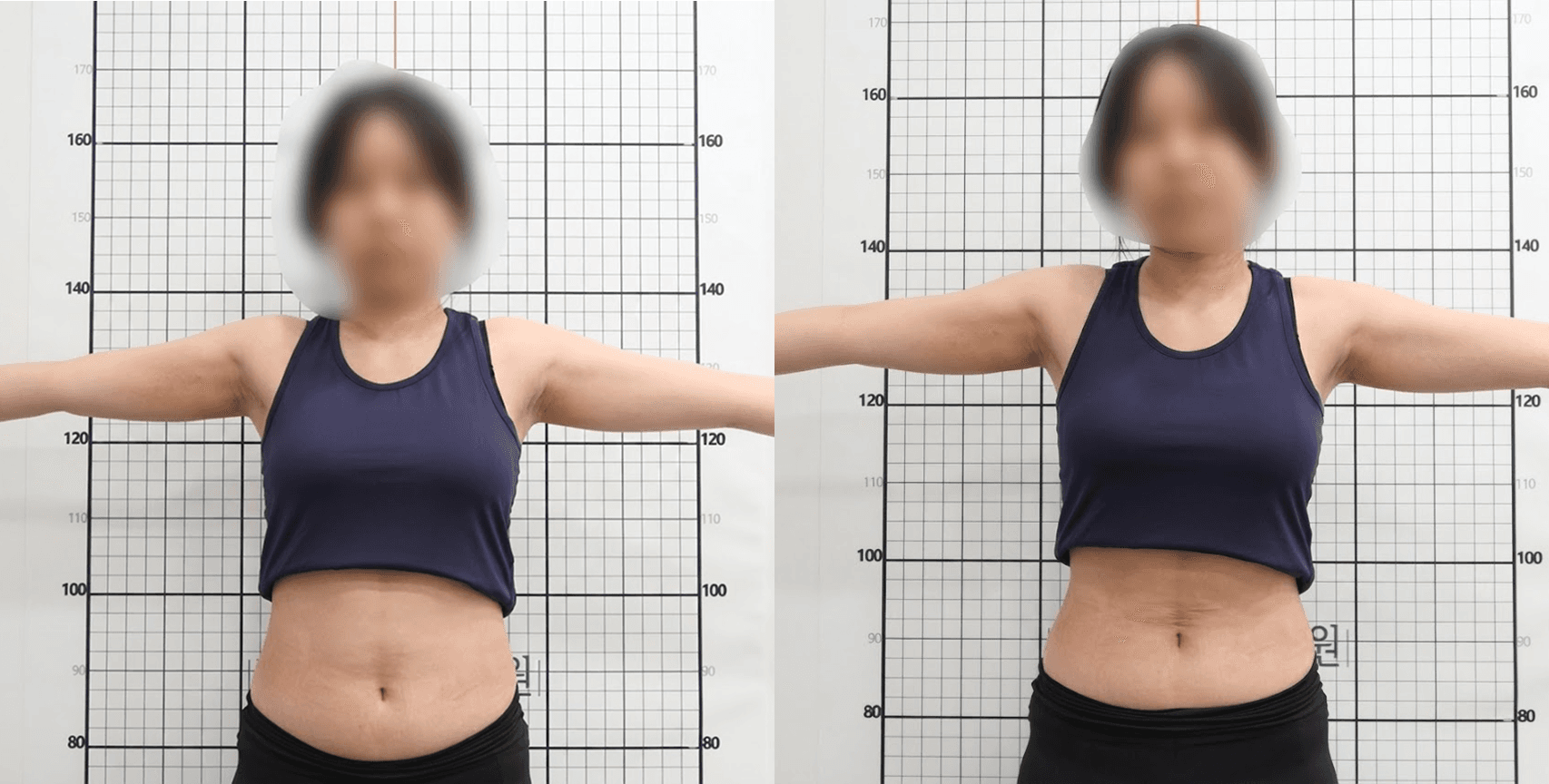 埋线治疗前后(正面)