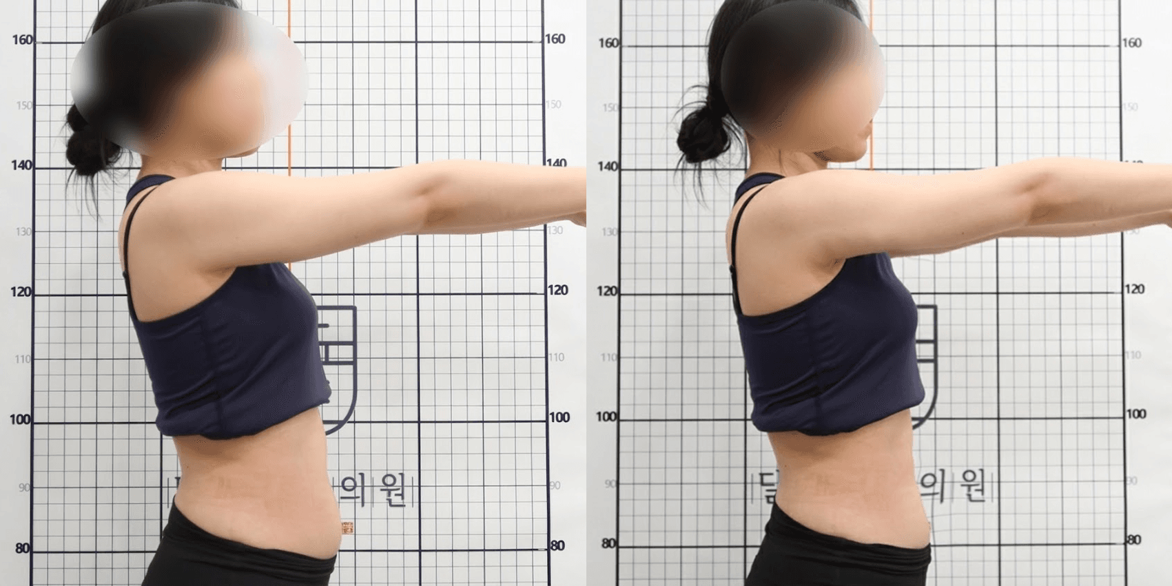 埋线治疗前后(侧面)