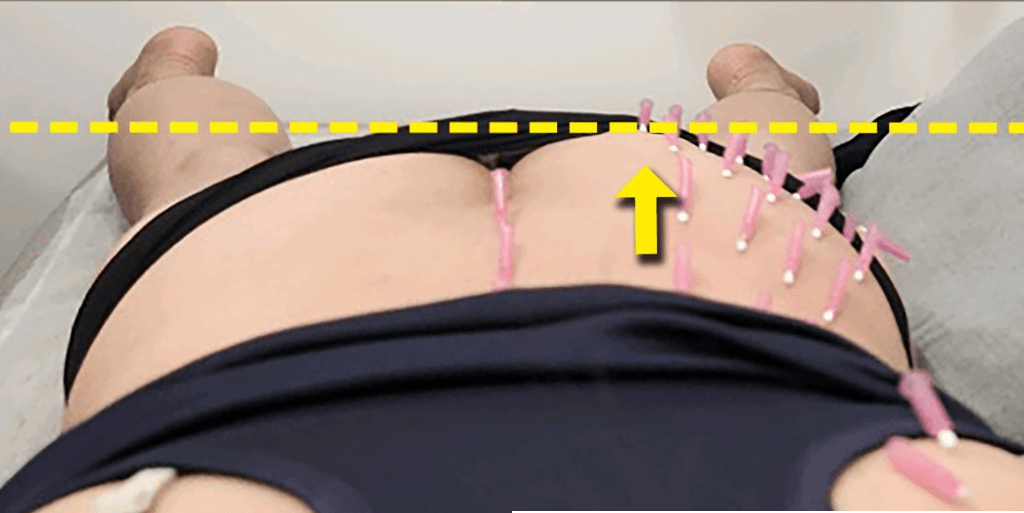 左右对比(右侧治疗后)