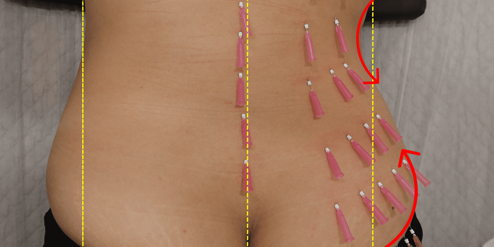 左右对比2(右侧治疗后)