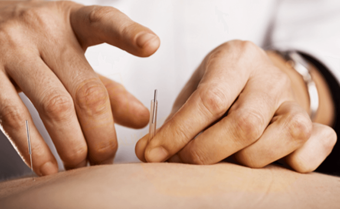 Brain Nerve Acupuncture