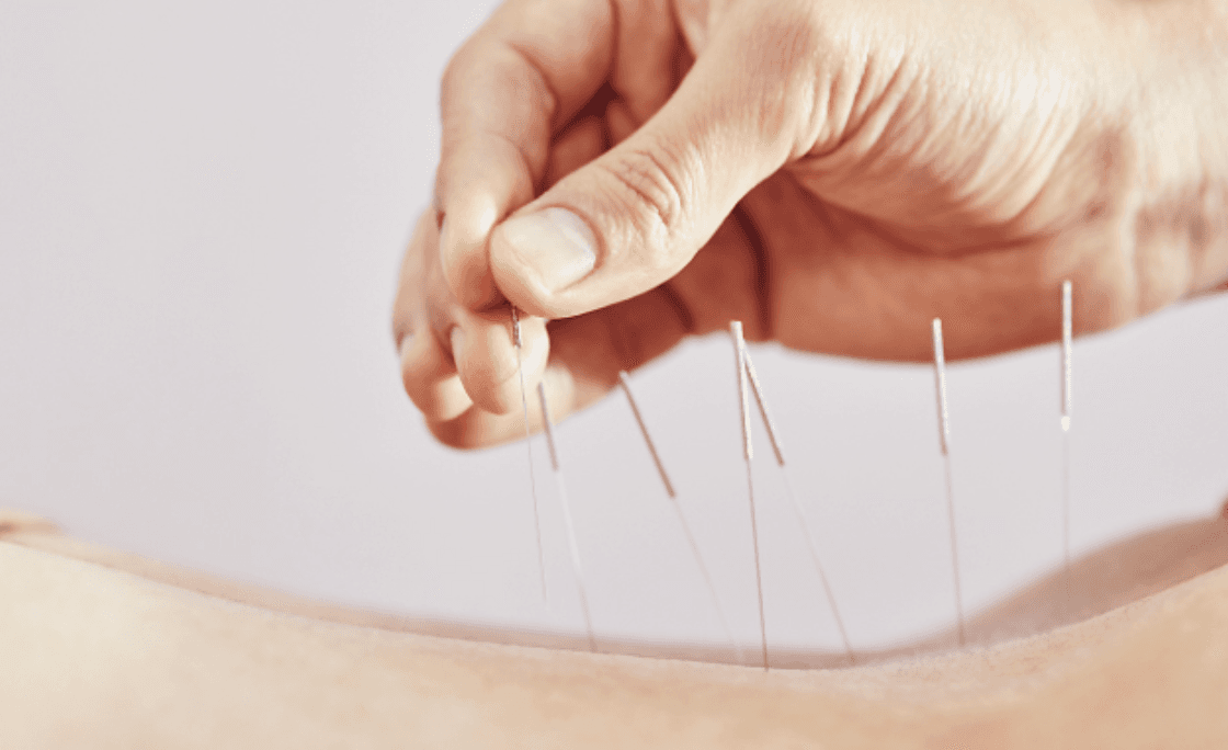 Thread Embedding Therapy